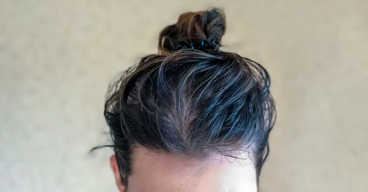 Oily or Greasy Scalp